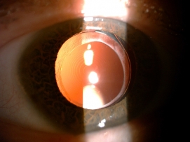 Göz İçi Lensler