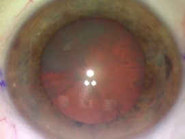 Cataract Eye Lens