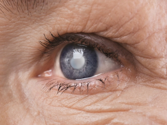 What is Cataract?