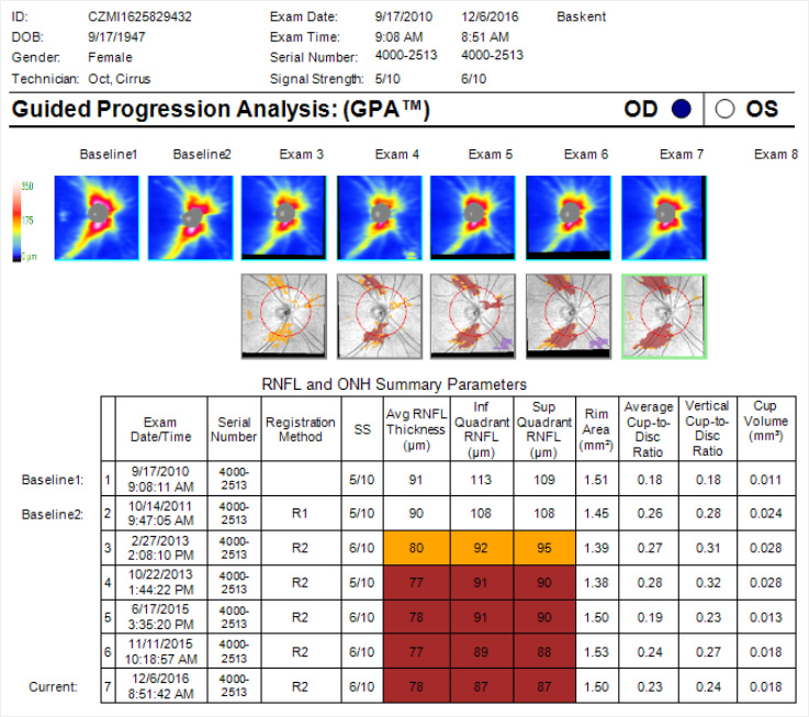 Glaucoma Tomography