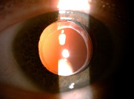 Smart Trifocal Lens